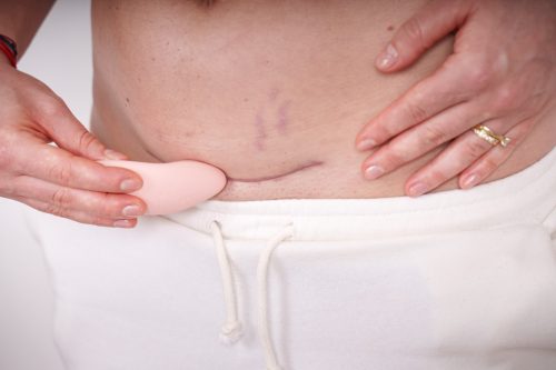 Momcare Laktációs és császármetszés utáni heg masszírozó