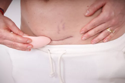 Momcare Laktációs és császármetszés utáni heg masszírozó