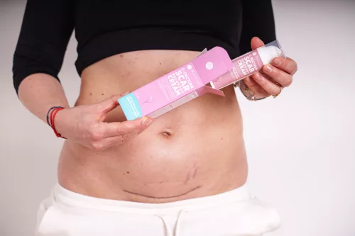 Momcare Császármetszés hegápoló krém 50ml