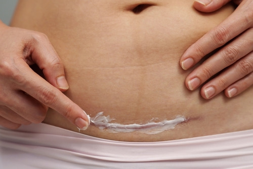 Momcare Császármetszés hegápoló krém 50ml