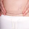 Momcare Császármetszés hegkezelő szilikontapasz 3db S-M