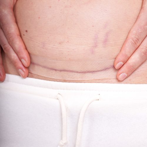 Momcare Császármetszés hegkezelő szilikontapasz 3db S-M