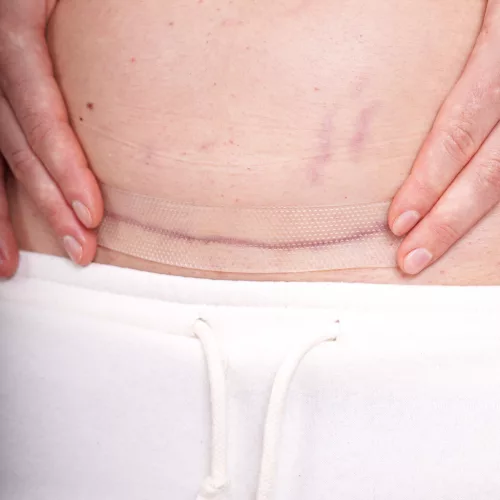 Momcare Császármetszés hegkezelő szilikontapasz 3db S-M