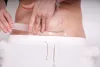 Momcare Császármetszés hegkezelő szilikontapasz 3db L-XL